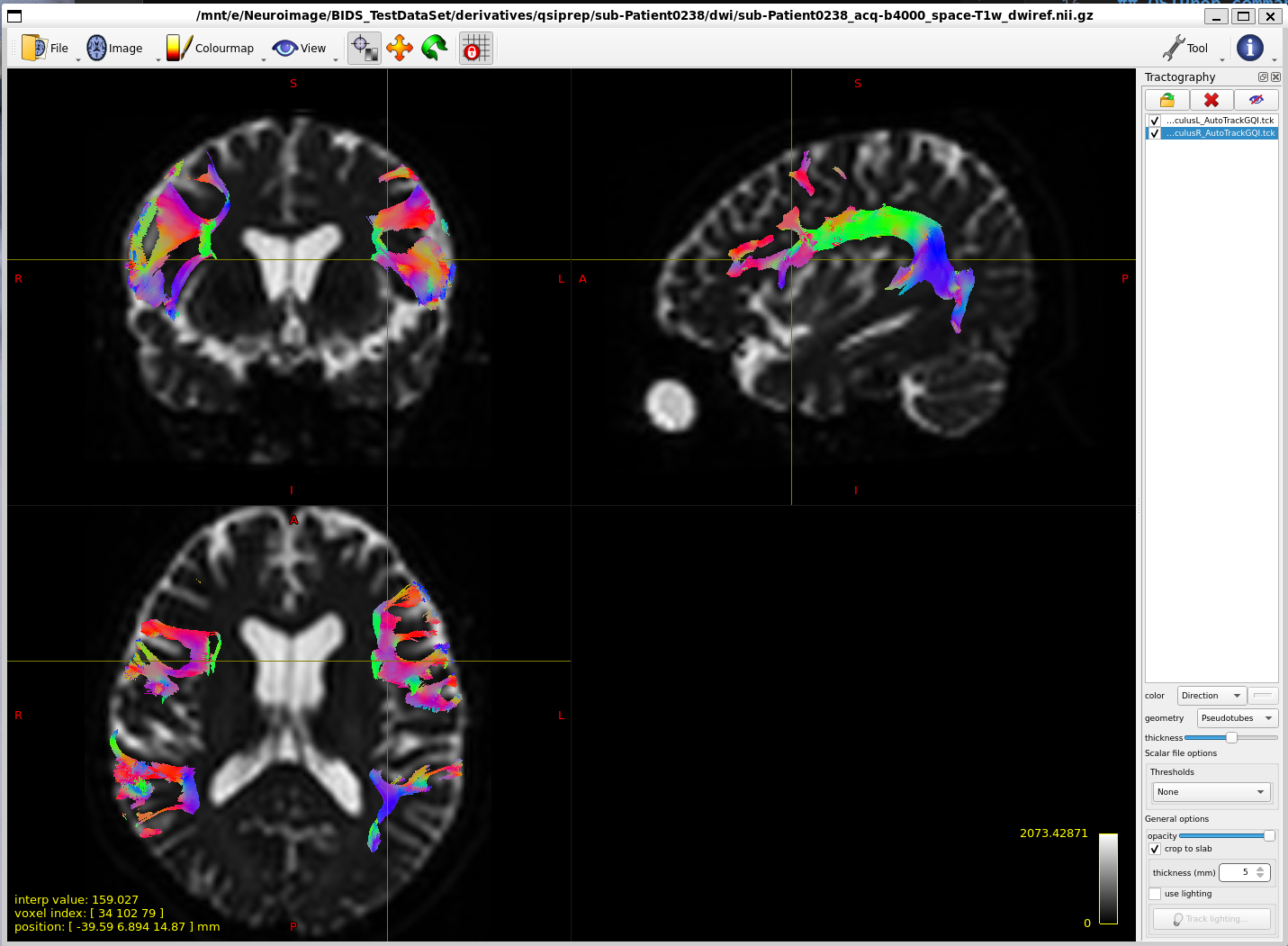 ArcuateFasciculus